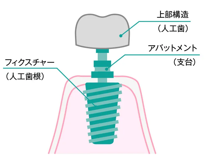 インプラント