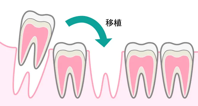 自家歯牙移植