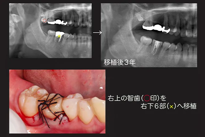 自家歯牙移植2