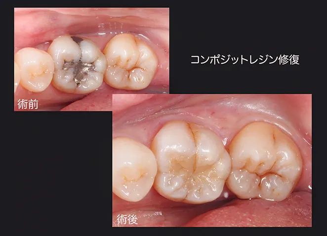 コンポジットレジン修復