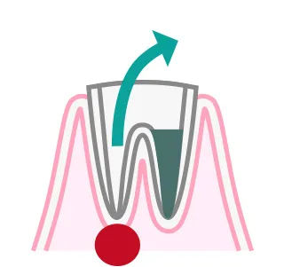 根管治療