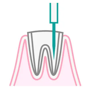 根管治療