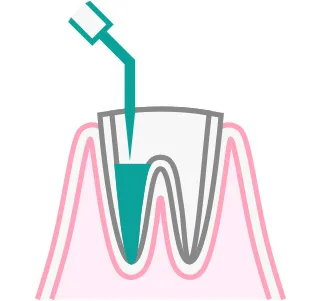 根管治療