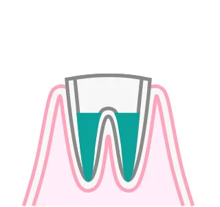 根管治療