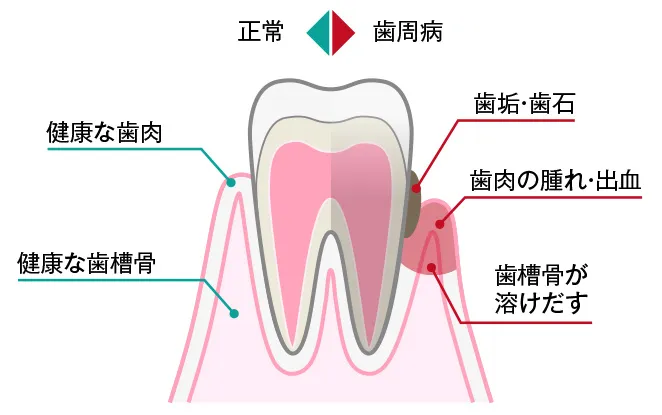 歯周病治療