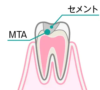 直接覆髄