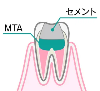部分的断髄