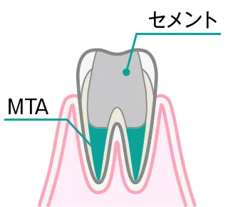 全部断髄