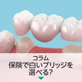 コラム|保険で白いブリッジを選べる?CAD/CAMブリッジの特徴と注意点