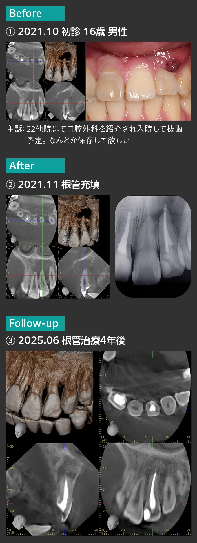 藤尾歯科医院での歯の保存