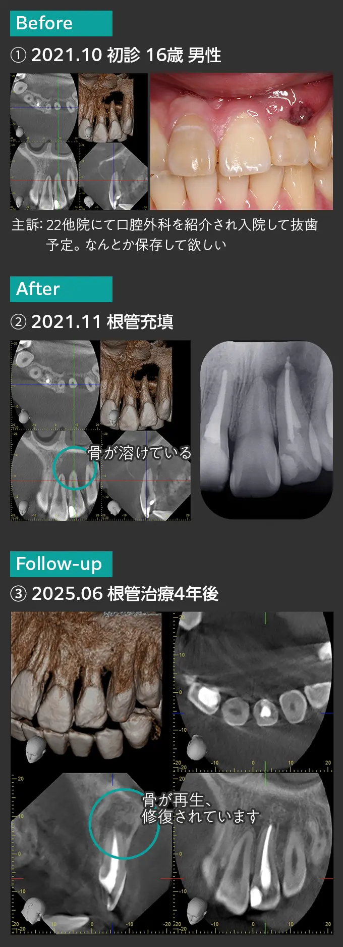 藤尾歯科医院での歯の保存