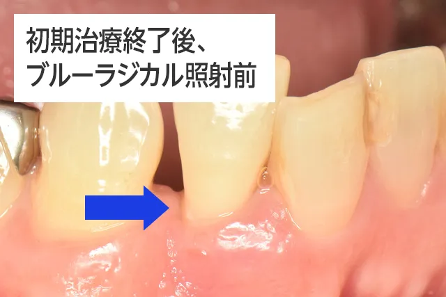 初期治療終了後、ブルーラジカル照射前