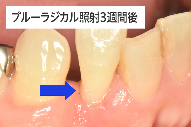 ブルーラジカル照射3週間後