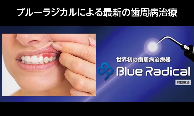 ブルーラジカルによる最新の歯周病治療｜藤尾歯科医院の取り組み