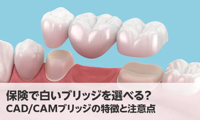 保険で白いブリッジを選べる？CAD/CAMブリッジの特徴と注意点