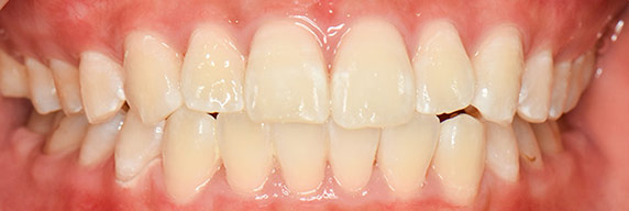コラム：藤尾歯科医院で受けられる歯のホワイトニング